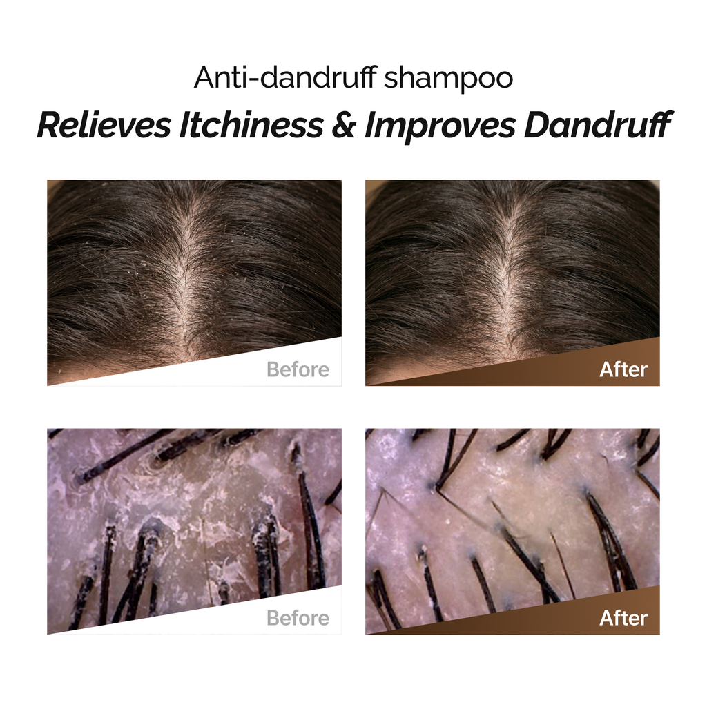 ROOTONIX Anti - Dandruff Shampoo