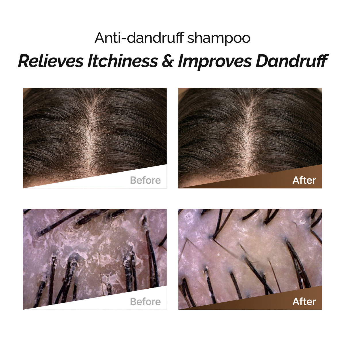 ROOTONIX Anti - Dandruff Shampoo
